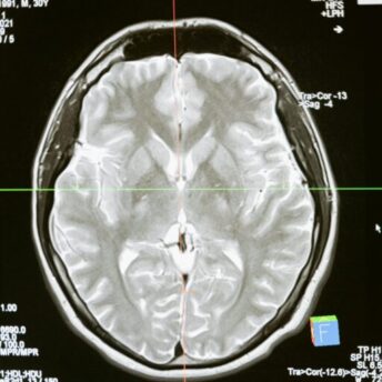 Intricate MRI brain scan displayed on a computer screen for medical analysis and diagnosis.